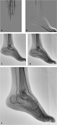 Case Report: An Unusual Case of Acute Lower Limb Ischemia as Precursor of the Asherson's Syndrome